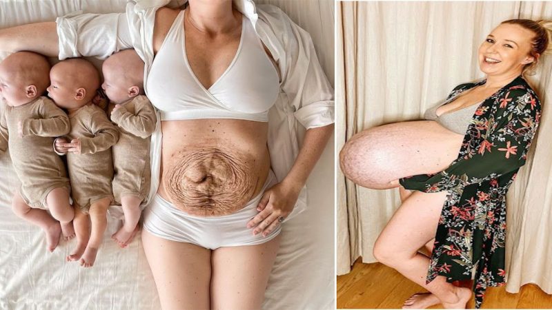 Michelle’s extraordinary triplets pregnancy journey.