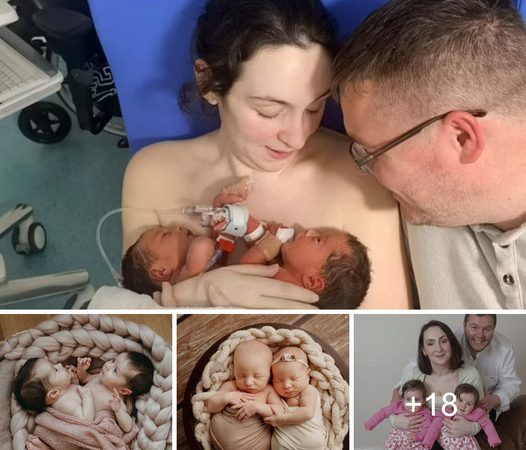 Conjoined Twins Detected in Ultrasound, Doctor Advises Termination, Yet Miraculous Outcome Occurs